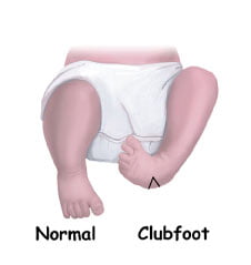 Babies left foot turned in, known as club foot caused by Arthrogryposis