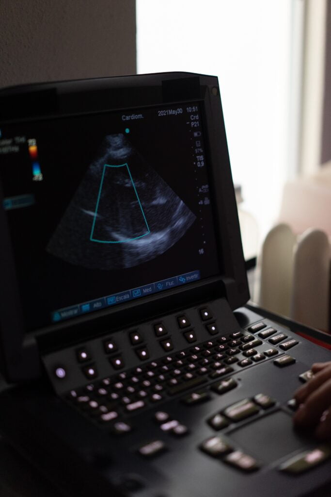 Echocardiogram machine scanning the heart